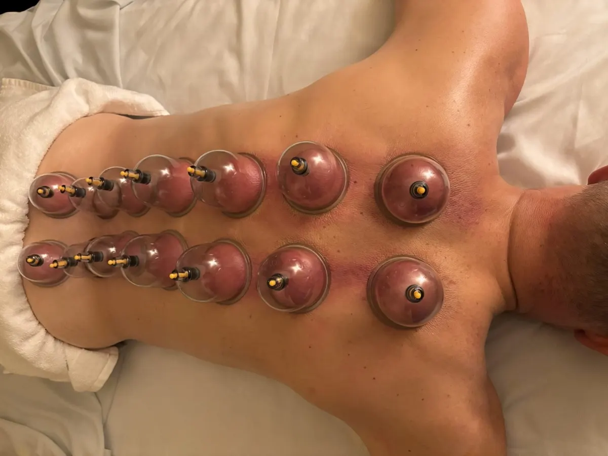 Cupping Therapy in Flower Mound and Colleyville